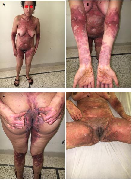 Figure 1: Figures A-B-C-D: Mmultiple diffuse post bullous erosive patches prevailing at the folds and neck and respecting the mucous membranes.