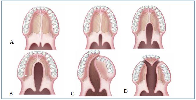 Figure 1: Veau classification: A-VEAU I: defects of the soft palate only, B-VEAU II: defects involving the soft and hard palate, C-VEAU III: defects involving the soft palate to the alveolus usually affecting the lip, D-VEAU IV: complete bilateral cleft.