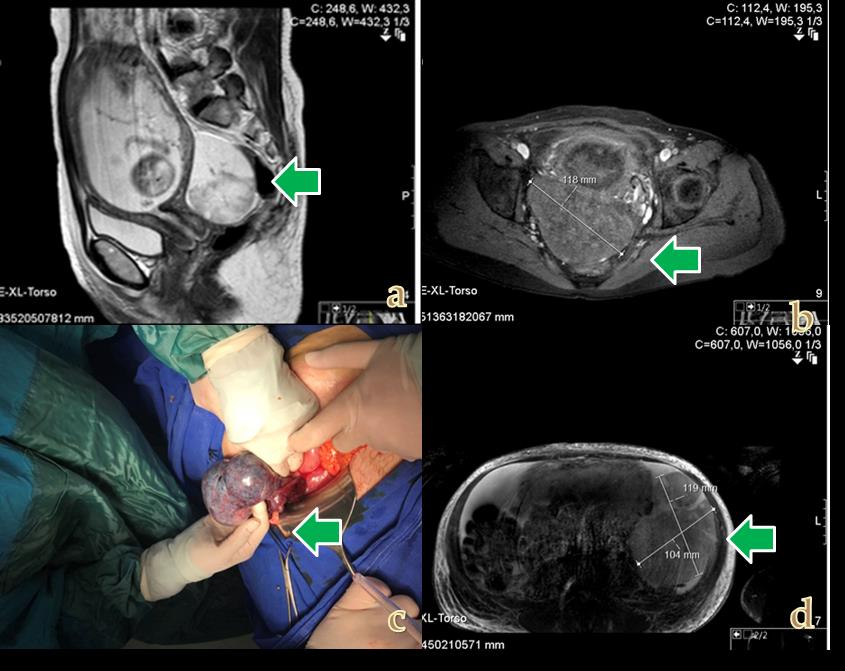 Figure 1: a-b: arrows indicated torsion of ovarian tumor in MR imaging in 16 weeks of gestation c: the appearance of the patient's ovarian torsion mass during operation d: 23 weeks of gestation MR image.