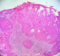 Figure 10: Squamous eddies, dyskeratotic keratinocytes and dermal lymphocytes in inverted follicular keratosis [16].