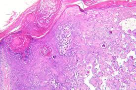 Figure 12: Squamoid follicles, eddies and keratinous, granular cells in inverted follicular keratosis [17].
