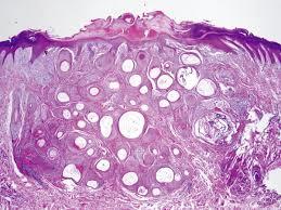 Figure 6: Squamous eddies, dyskeratotic keratinocytes with lymphocytic infiltration in inverted follicular keratosis [15].