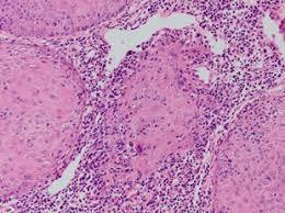 Figure 8: Squamous eddies, hyperkeratosis, parakeratosis, acanthosis and uninvolved superficial epithelium in inverted follicular keratosis [16].