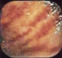 Figure 2: Linear erythematous spots.