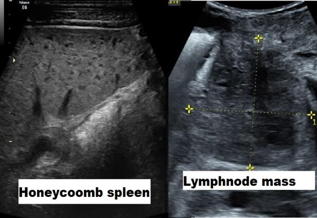 Figure 1: Abdominal ultrasound showing.