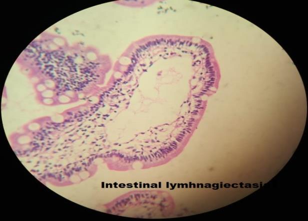 Figure 3: Duodenal biopsy H& E 40 X: showing Intestinal Lymphangiectasia.