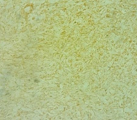 Figure 2: 2A-2C: Histopathology of Chondrosarcoma.