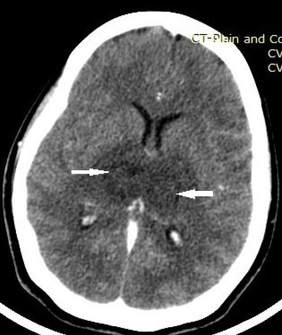 Figure 2: There was no post contrast parenchymal or leptomeningeal enhancement or filling defect in the sinuses.