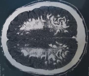 Figure 1: CT scan axial free showing calcification of basal ganglia, parieto-occipital cortical furrows.
