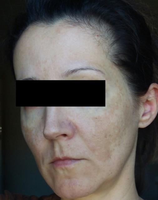Figure 1: Before isotretinoin treatment, left face.