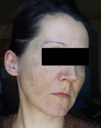 Figure 3: Before isotretinoin treatment, right face.