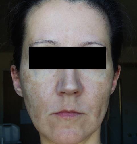 Figure 5: Before isotretinoin treatment, frontal face.