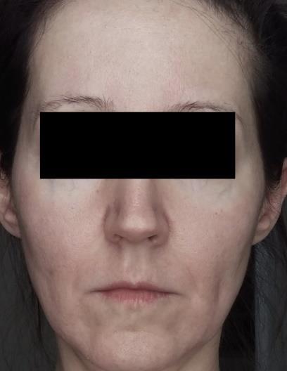 Figure 6: After isotretinoin treatment, frontal face.