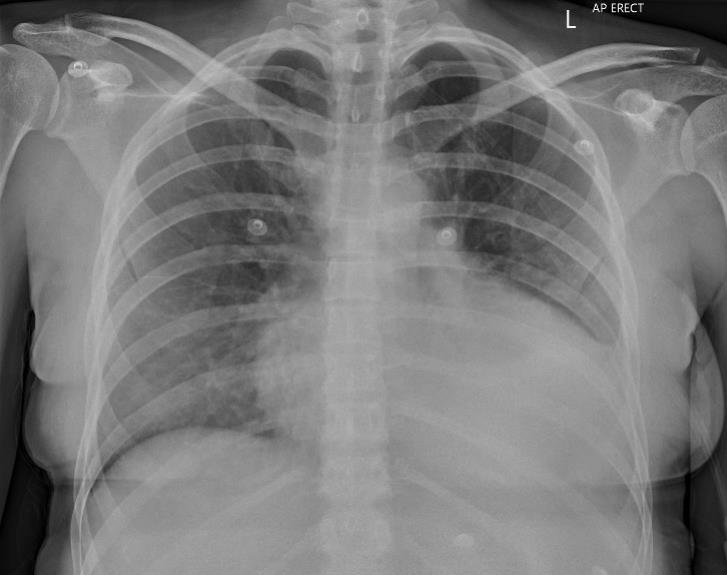 Figure 1: Chest Xray (CXR) showing a left sided pleural effusion.