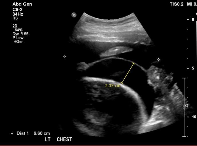Figure 2: Ultrasound of Chest (USS) showing a left sided pleural effusion.