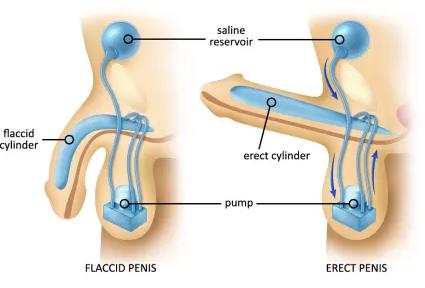 Figure 1: Spectrum of Erectile dysfunction.