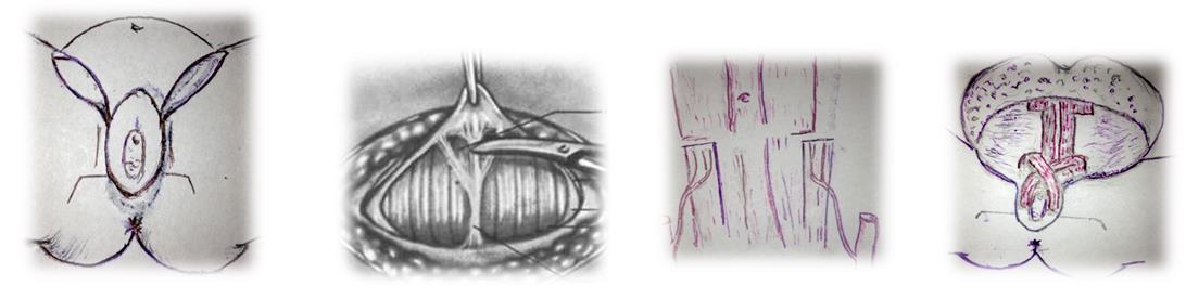 Figure 4: a) excision of the vulva and inguinal areas; b) and c) slit with a Pfannenstiel exposure of the rectus muscles and and epigastrica inferior; d) formirovanie of the labia majora cross segments of the rectus muscles.