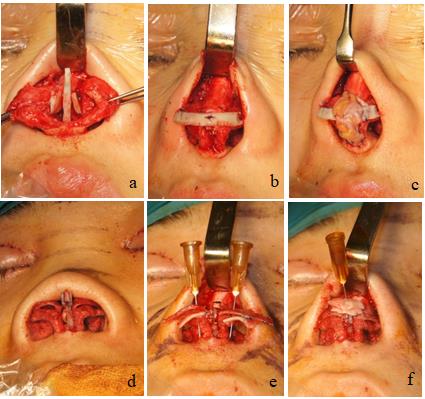 Figure 2: Schematic diagram of correction of nasal soft triangle deformities; a and b shows the correction method using autologous costal cartilage; c shows fascia tissue transplantation; d, e, f is the correction method using autologous septal cartilage + ear cartilage.