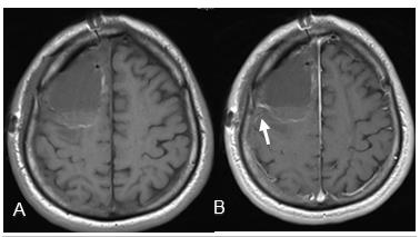 Figure 2: EPMRI (24 hours post op) A: Axial T1 – weighted B: Axial T1-post contrast Status post frontal craniotomy for grade IV glioblastoma resection Edema and hemorrhage along resection cavity representing post-surgical changes.