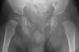 Figure 1: Management plan for a child with suspected septic arthritis.