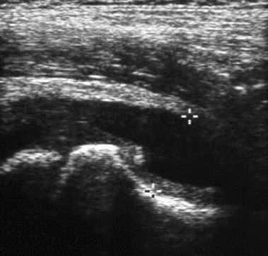 Figure 3: Ultrasonogram of right hip showing widening joint space of right hip.