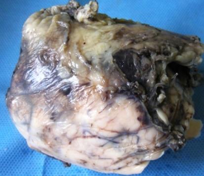 Figure 1: Encapsulated tumor of the thymus.