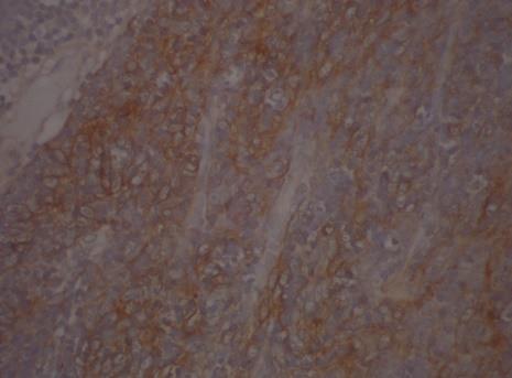 Figure 3: PAN CK - Positive for thymic epithelial cells.