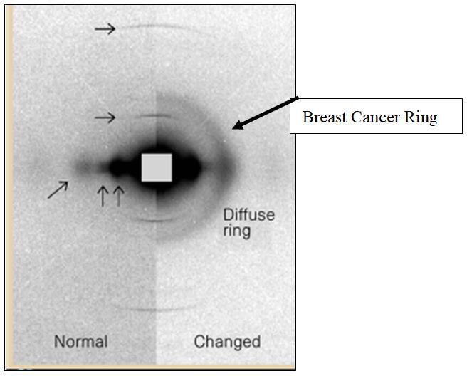 Figure 1: There have been no false negatives amongst the 4500+ samples completed so far. A number of false positives have subsequently been shown to be correct. One of these was marked as false positive, two years in a row. She died in the next year from breast cancer, finally diagnosed by mammography.