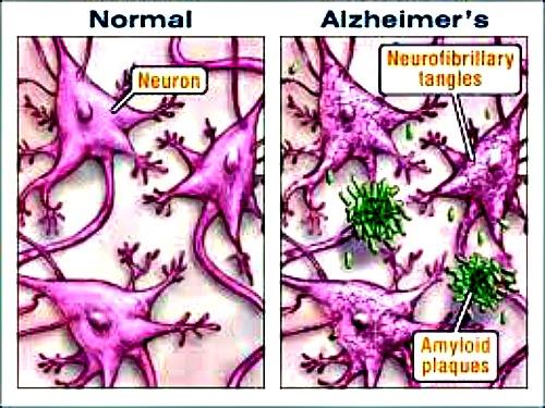 Figure 4: Alzheimer can be characterized by Senile plaques that consist of extracellular amyloid beta (Aβ) deposition while neurofibrillary tangles (NFT) consisting of hyperphosphorylated tau which are located intracellular in Alzheimer Diseased brain.