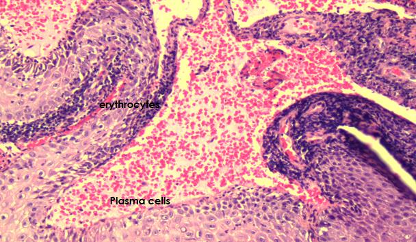 Figure 3: Lymphangioma circumscriptum. a) Baseline image of lesions on the left side of back. b) One week post- procedure using CO2 laser cutting and ablation with a power setting of 10 watts and a defocused 2.0-mm beam. There was noted decrease in crusting, erythema, and there was flattening of some lesions.