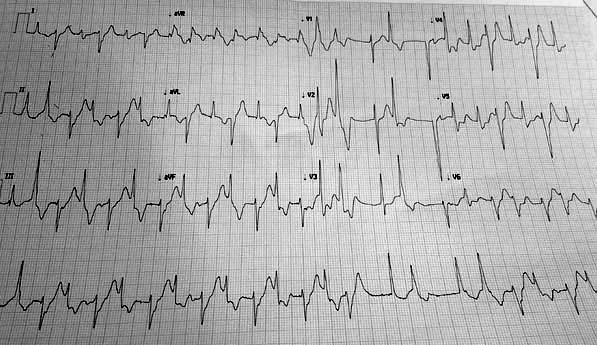 Figure 1: Electrocardiogram showing bidirectional ventricular tachycardia following aconite poisoning.