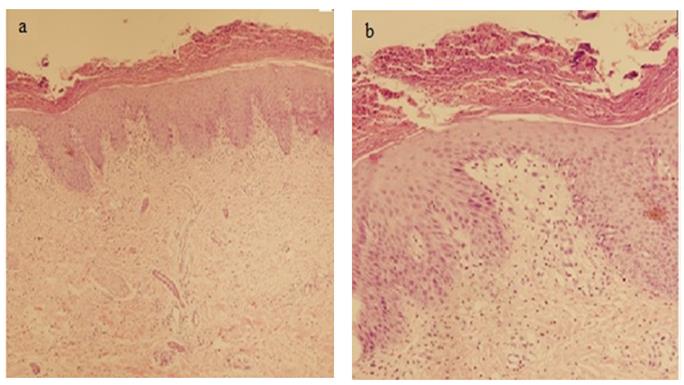 Figure 2: a) Regular acanthosis and extensive parakeratosis with neutrophil aggregates (H&EX 100); b) Thinning of suprapapillary plate, absence of granular layer with neutrophil exocytosis and accumulation in parakeratotic layers and papillary dermal edema with mixed inflammatory infiltrate (H&E X 200).