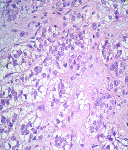 Figure 2: a) Neoplasm that extended from the superficial dermis to the subcutaneous cellular tissue with tubular- squamous pattern b) Strands of clear cytoplasm cells C) Perineural infiltration. A palliative resection was made and chemotherapy and radiotherapy treatments, 8 months later the patient died due to meninges infiltration.