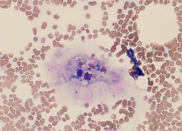 Figure 2: Bone Marrow showing single hemophagocytic histiocyte containing predominantly ingested red blood cells and erythroid precursors.