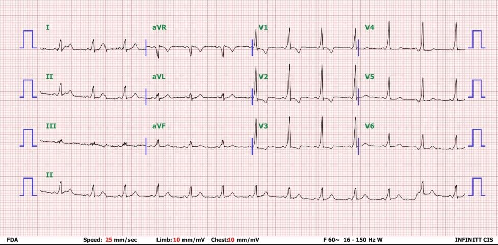 Figure 1: Electrocardiogram demonstrating WPW syndrome.