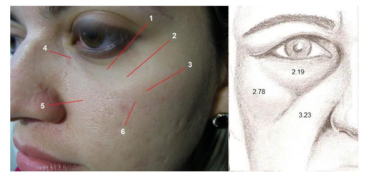 Figure 1: Left: Malar region, containing three different anatomical areas (1) skin of the orbital region, (2) palpebromalar groove (3) skin of the zygomatic region, (4) nasolacrimal sulcus, (5) Skin of the buccal region, and (6) buccal zygomatic groove. Right: Skin thickness in each area, in millimeters.