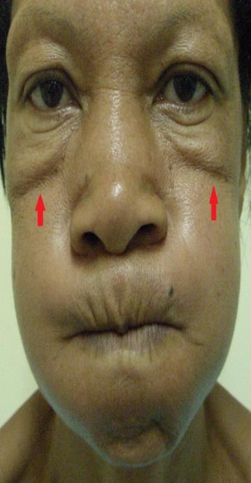 Figure 10: V-Shaped deformity, highlighted in red.