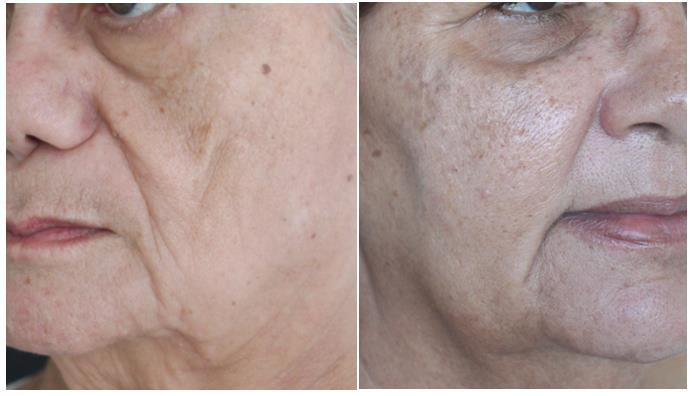 Figure 13: Labiomental groove formed by the transition between the excess skin along with the subcutaneous adipose compartment of the jowl, laterally, and the lower labial skin with scarce subcutaneous tissue. The crease may start in the corner of the mouth (left - red arrows), or can be continuous with the nasolabial groove, lateral to the modiolus (right - yellow arrows).
