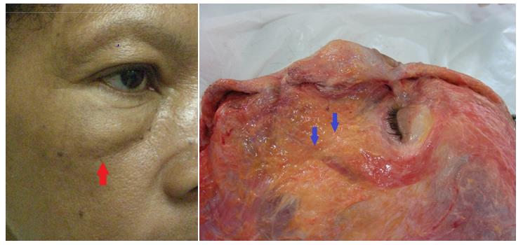 Figure 7: Palpebromalar groove (red arrows), located below the orbital border (blue arrows)
