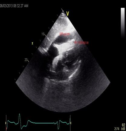 Figure 1: Subcostal view showing RV collapse and pericardial effusion causing ventricular arrythmia.