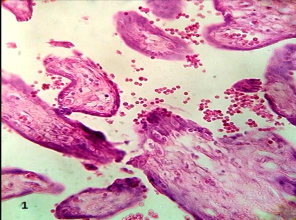 Figure 1: The interruption of the syncytium is communicating stromal region with the intervillous space in some villi.400x.H&E.