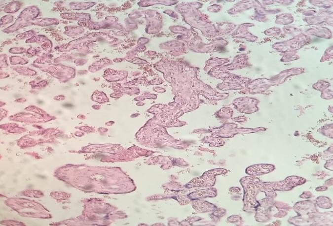 Figure 3: Cells of a cellular island have lost their cytoplasm.400x.H&E.