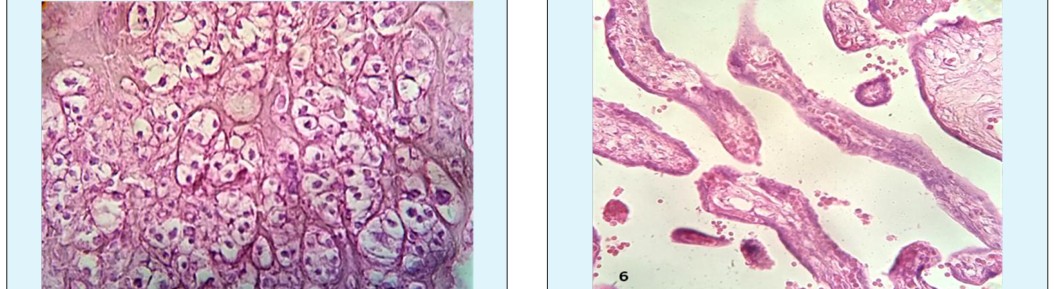Figure 5: Placental ramification present feature of immaturity (arrow).100x.H&E.