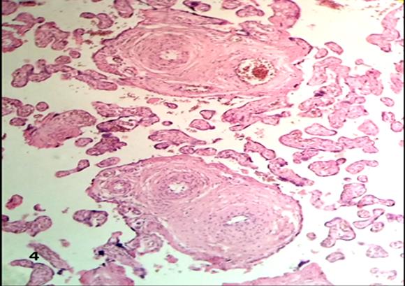 Figure 6: Mature intermediate villi have lost syncytium and lack of terminal villi.100x.H&E.