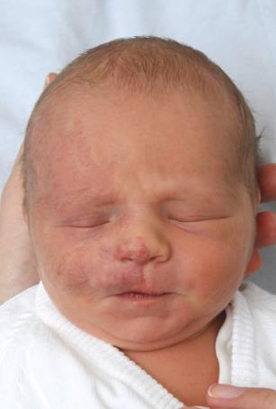 Figure 1: The discoloration intensified with crying. There were no complications during pregnancy or birth. The mother gave birth at the age of 36.