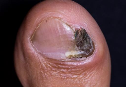 Figure 1: Nail margin involvement with hyperchromic dystrophy and hyperkeratosis.