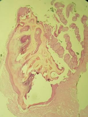 Figure 3: Histopathology evidencing digitiform projections covered by stratified squamous epithelium with dense stroma.