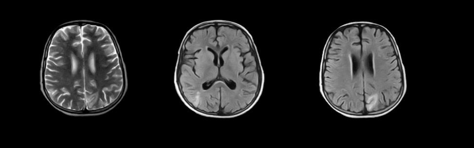 Figure 1: MR showing hypointense signal in the parieto-occipital regions and showing symmetrical hypo densities in parieto-occipital regions of cerebral hemispheres.