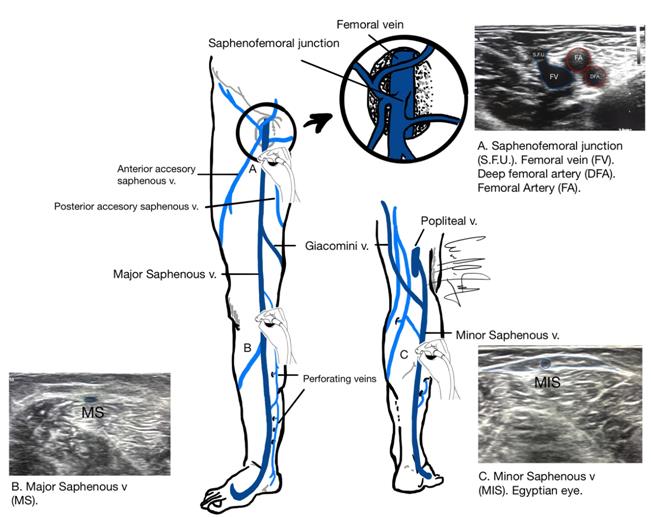 Figure 1: Initial puncture of the greater saphenous vein with ultrasound guidance.