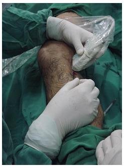 Figure 2: Vascular introducer 7F in the greater saphenous vein and radiofrequency catheter ready to advance.